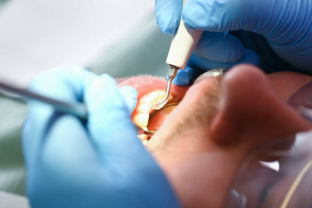 Best Emergency Treatment for Dental Infections or Abscesses in Rosedale, MS